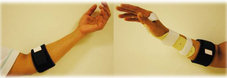 Tratamentul epicondilitei articulației cotului la mâna dreaptă