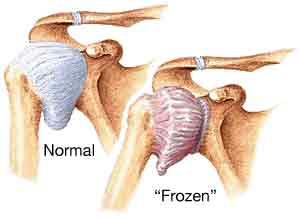 Bursita articulației genunchiului doare Cât de periculos bursita genunchiului și cum să-l trateze?