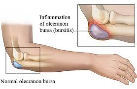 inflamația cotului tratamentul articulației bursitei)