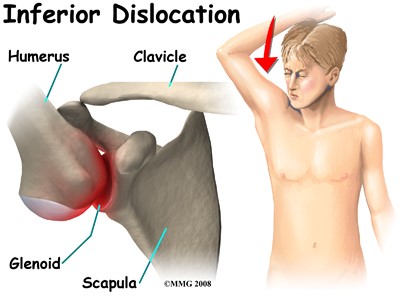 leziuni vasculare cu luxația articulației umărului