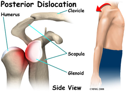 tratamentul articulației umărului după căderea pe braț durere și fluid în articulația genunchiului