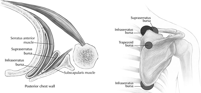 bursita omoplat inflamația și tratamentul articulației șoldului