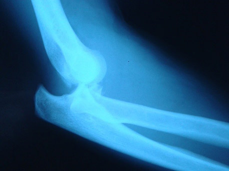 tratamentul luxației articulațiilor cotului la domiciliu deteriorarea ligamentului lateral intern al articulației genunchiului drept