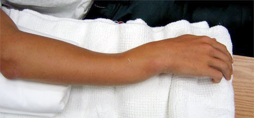 fractură de mână cu tratament de deplasare reumatismul articular semnează un tratament