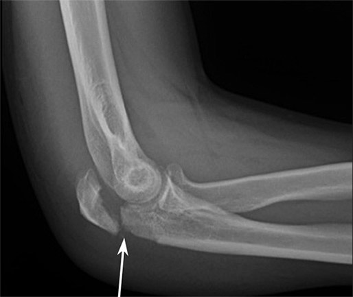 tratament pentru fracturile articulației cotului condroitine și glucozamină