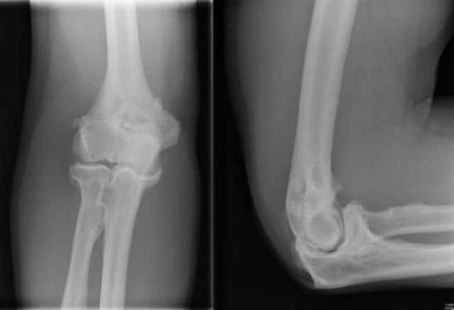 Deforma artroza articulației cotului 3 grade
