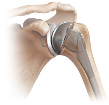 osteochondroza acută a genunchiului debridarea articulară în artroză